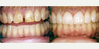 Dental Crown before and after photo