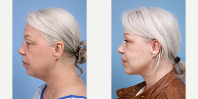 Eyelid Surgery before and after photo
