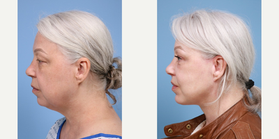 Eyelid Surgery before and after photo