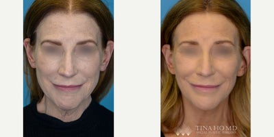 Facelift before and after photo