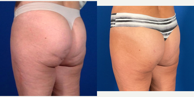 Acoustic Wave Therapy before and after photo