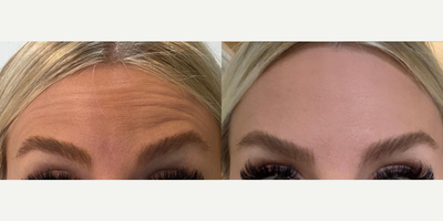 Botox before and after photo