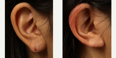 Earlobe Repair before and after photo