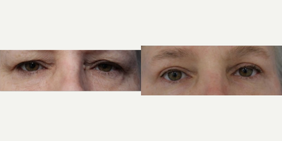 Eyelid Surgery before and after photo