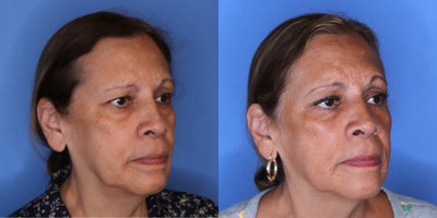 Eyelid Surgery before and after photo