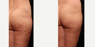 Cellfina before and after photo