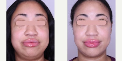 Cheek Fillers before and after photo