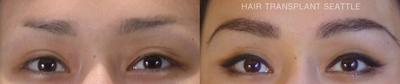 Eyebrow Transplant before and after photo