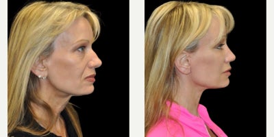 Facial Fat Transfer before and after photo