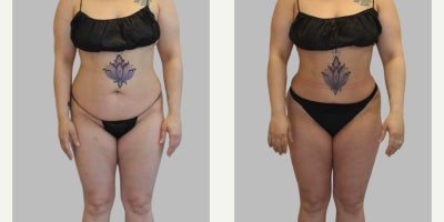 Liposuction before and after photo