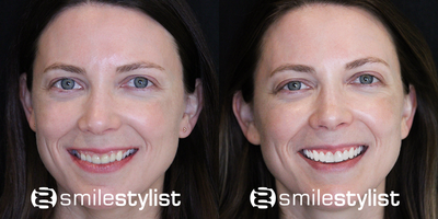 Porcelain Veneers before and after photo