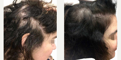 PRP for Hair Loss before and after photo