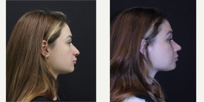Rhinoplasty before and after photo