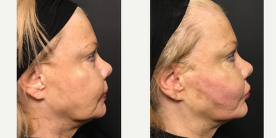 Thread Lift before and after photo
