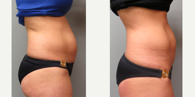 UltraShape before and after photo