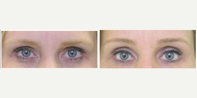 Brow Lift before and after photo