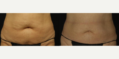 CoolSculpting before and after photo