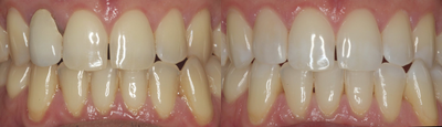 Dental Crown before and after photo