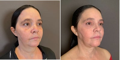 Neck Lift before and after photo