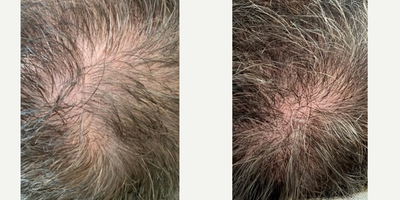 PRP for Hair Loss before and after photo