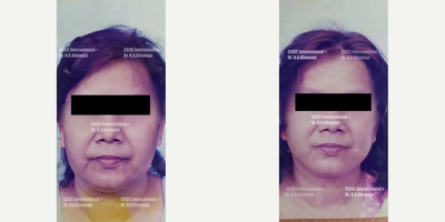 Thread Lift before and after photo