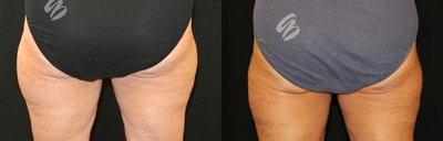 CoolSculpting before and after photo