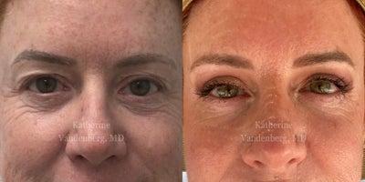 Double Eyelid Surgery before and after photo