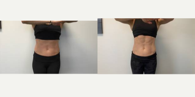 Emsculpt before and after photo