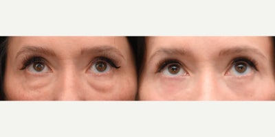 Eyelid Surgery before and after photo