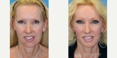 Facial Fat Transfer before and after photo