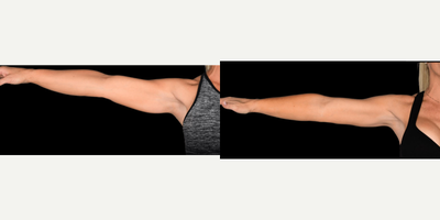 Liposuction before and after photo