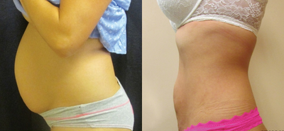 Smart Lipo before and after photo