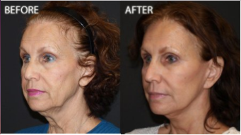 Facelift before and after photo