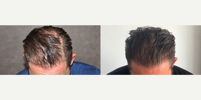 Hair Transplant before and after photo