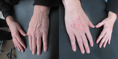 Hand Rejuvenation before and after photo