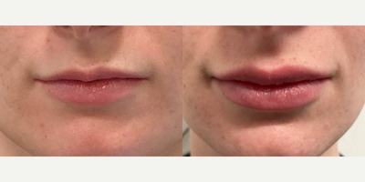 Lip Fillers before and after photo