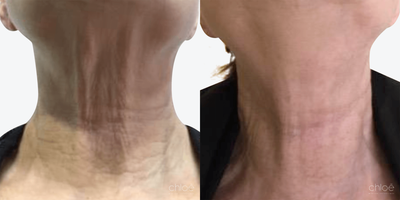 Nonsurgical Neck Lift before and after photo