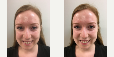 Facial before and after photo