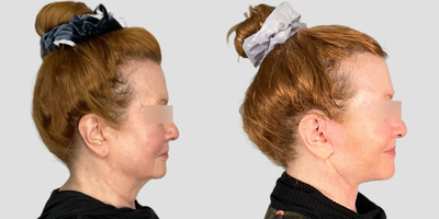 Neck Lift before and after photo