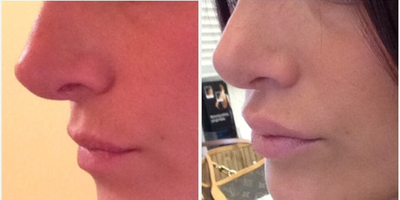 Restylane Silk before and after photo
