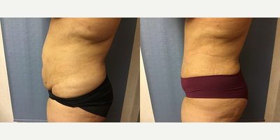 Tummy Tuck before and after photo