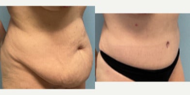Tummy Tuck before and after photo