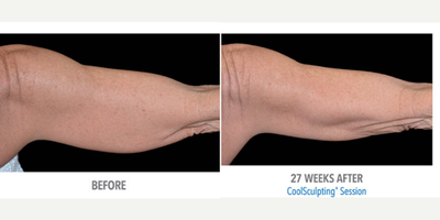 CoolSculpting before and after photo