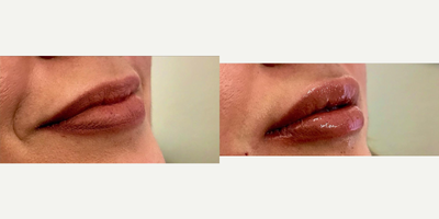 Restylane Refyne before and after photo