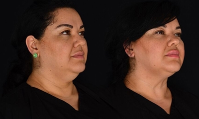 Chin Liposuction before and after photo