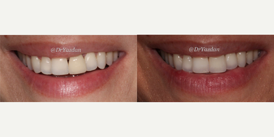 Dental Crown before and after photo