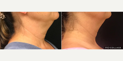 Exilis before and after photo