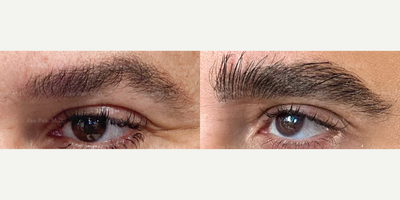 Eyebrow Transplant before and after photo