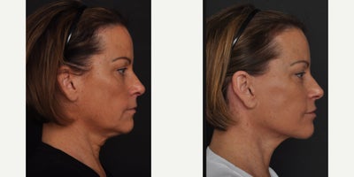 Facelift before and after photo