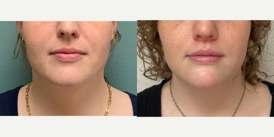 Lip Lift before and after photo
